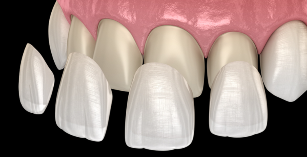 Veneers Vadodara